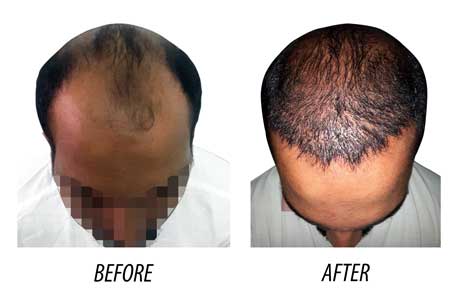Hair Transplant in Trivandrum - Hair Specialist in Kerala | TrueSelf