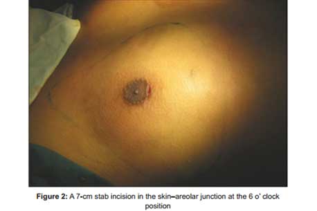 7cm-stab-incision-in-the-skin-areolar-junction-at-the-6-o-clock-position