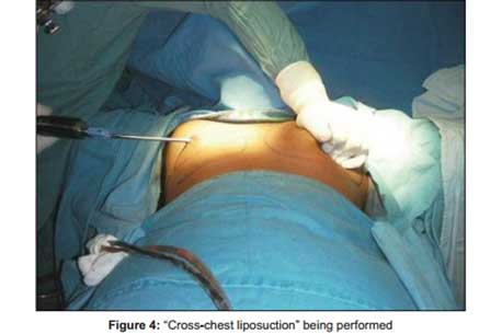 Cross-chest-liposuction-being-performed