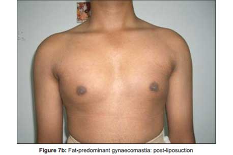 fat-predominant-gynaecomastia-post-liposuction