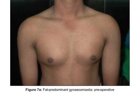 fat-predominant-gynaecomastia-pre-operative