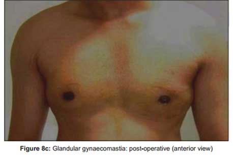 glandular-gynaecomastia-post-operative-anterior-view