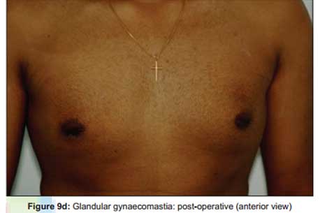 glandular-gynaecomastia-post-operative-anterior-view2