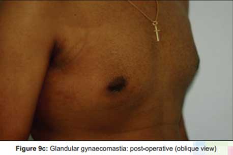 glandular-gynaecomastia-post-operative-oblique-view2