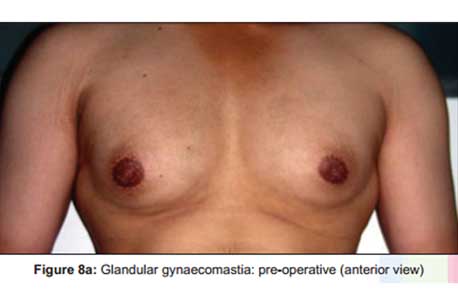 glandular-gynaecomastia-pre-operative-anterior-view