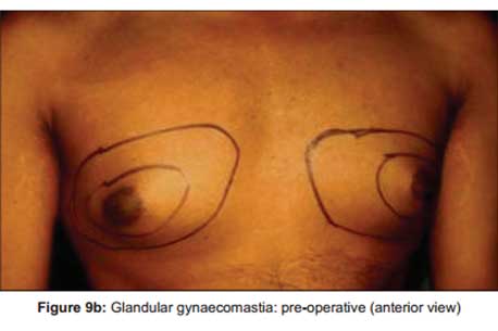 glandular-gynaecomastia-pre-operative-anterior-view2