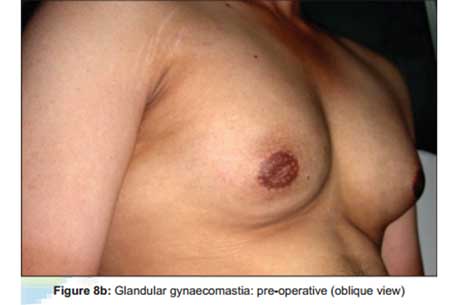 glandular-gynaecomastia-pre-operative-oblique-view