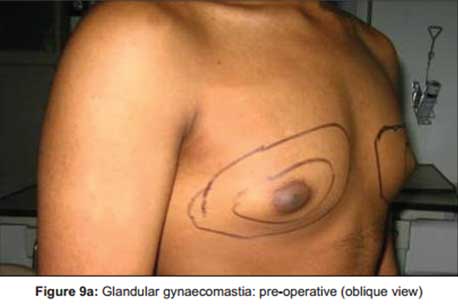 glandular-gynaecomastia-pre-operative-oblique-view2