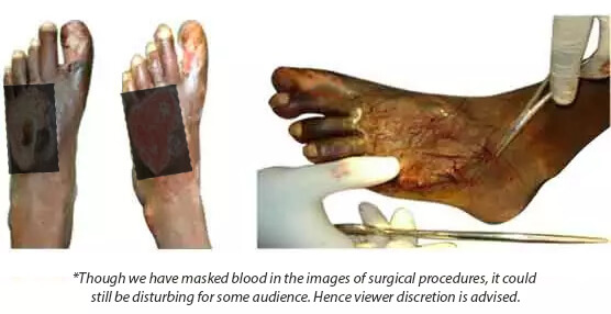 Limb Salvage Procedure